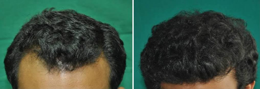 GFC Hair Density Result